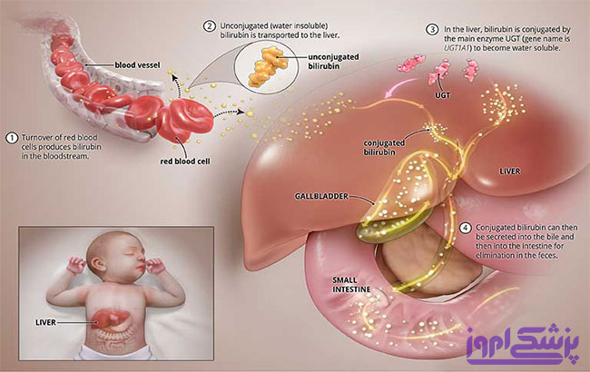 عوامل خطر آفرین در زردی نوزاد،زردی،یرقان،بارداری،نوزاد، بیلی‌روبین 